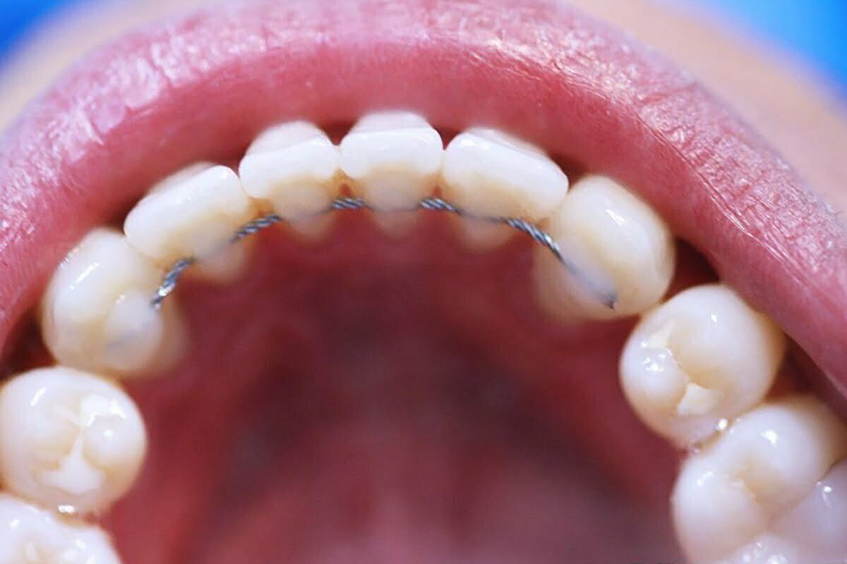 Retenedores dentales: ¿Qué son y para qué sirven? 3