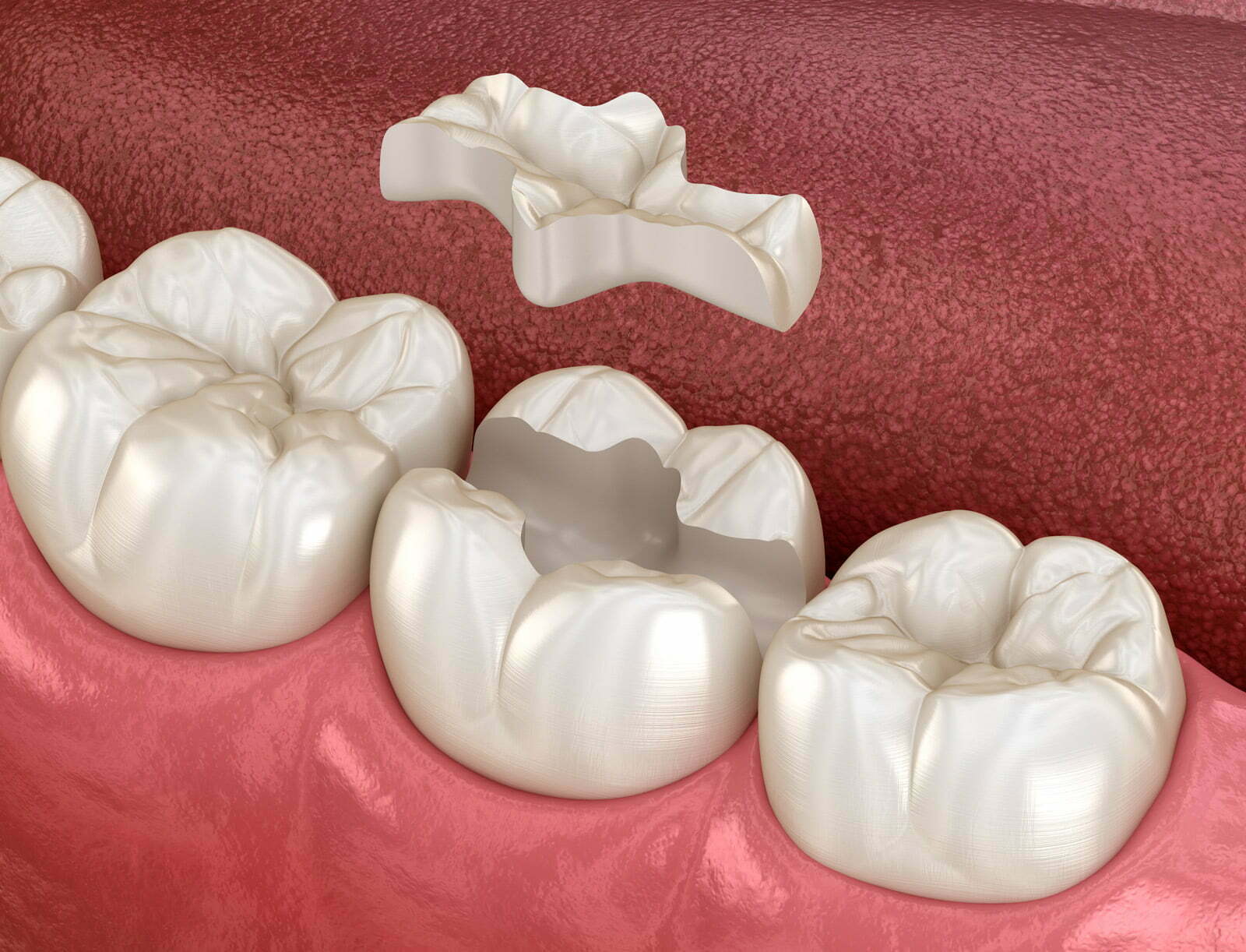 ¿Qué es y cuándo se realiza una incrustación dental? 1