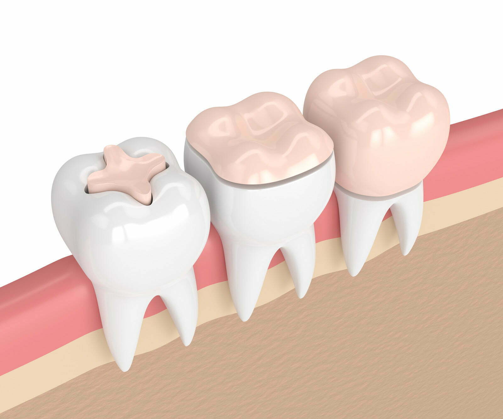 ¿Qué es y cuándo se realiza una incrustación dental? 2