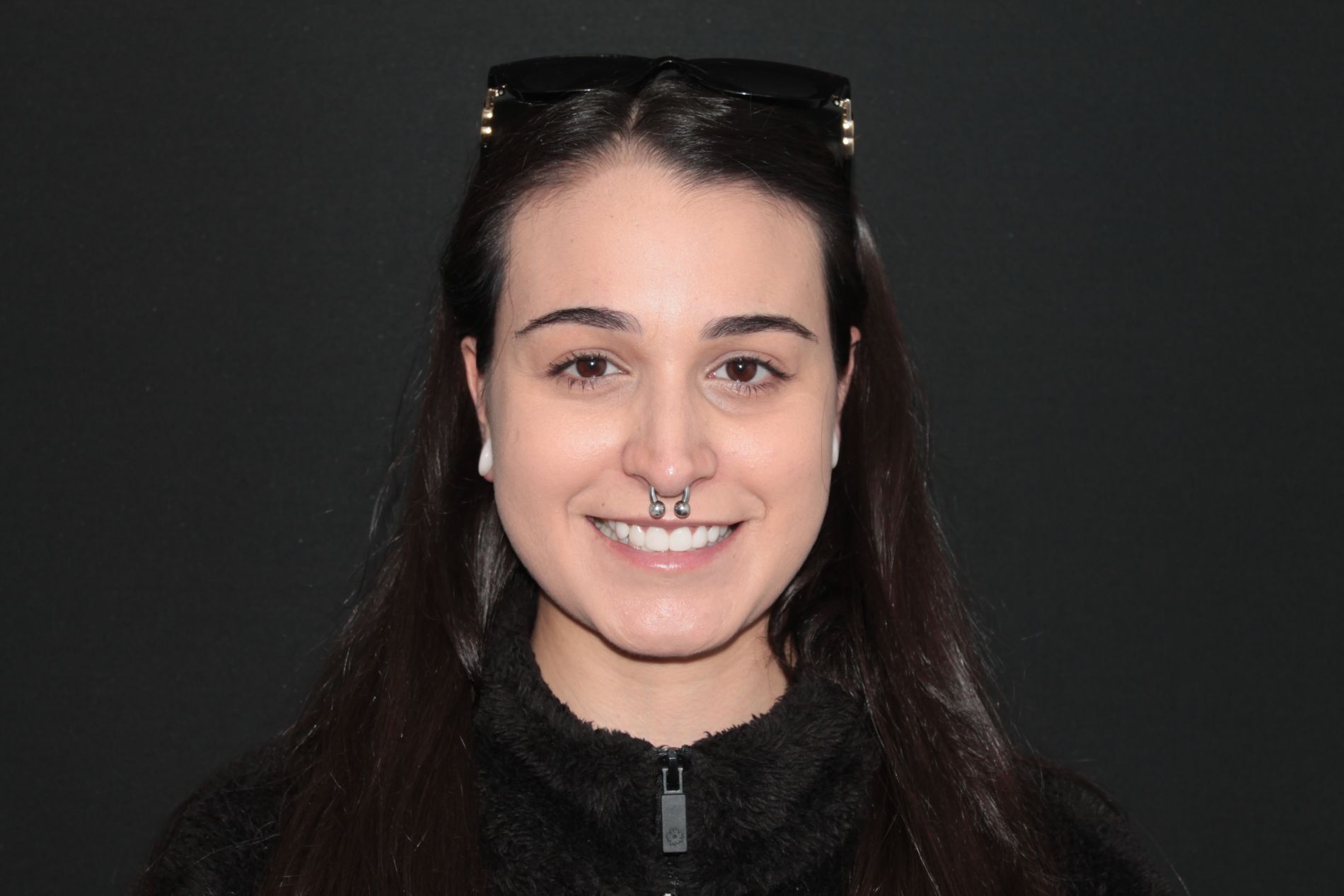 carilla dental antes y despues