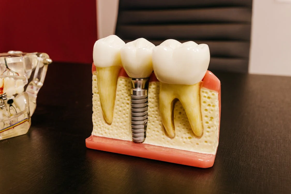 sintoma rechazo implante dental