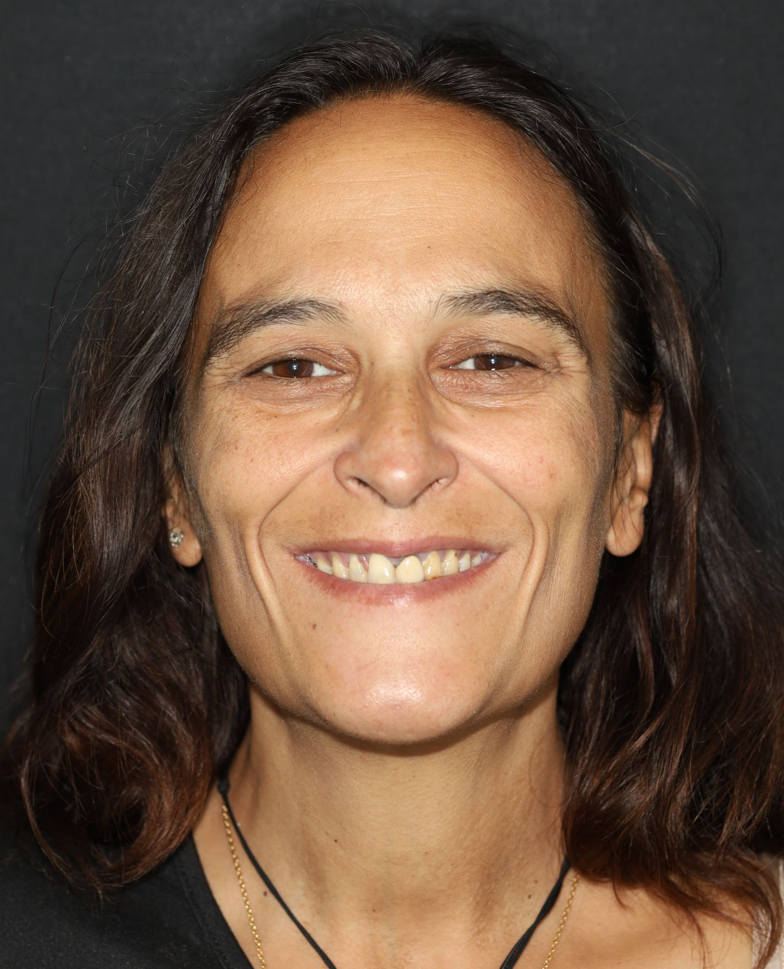 implantes dentales antes y despues