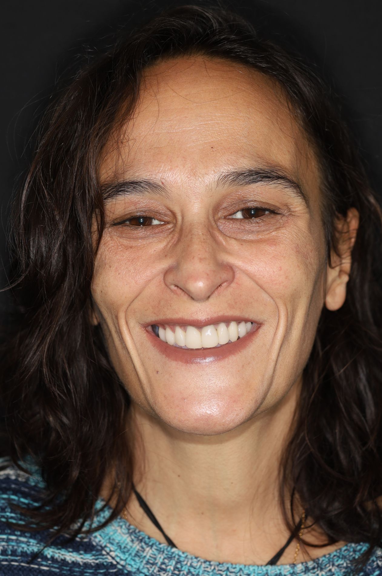 implantes dentales antes y despues