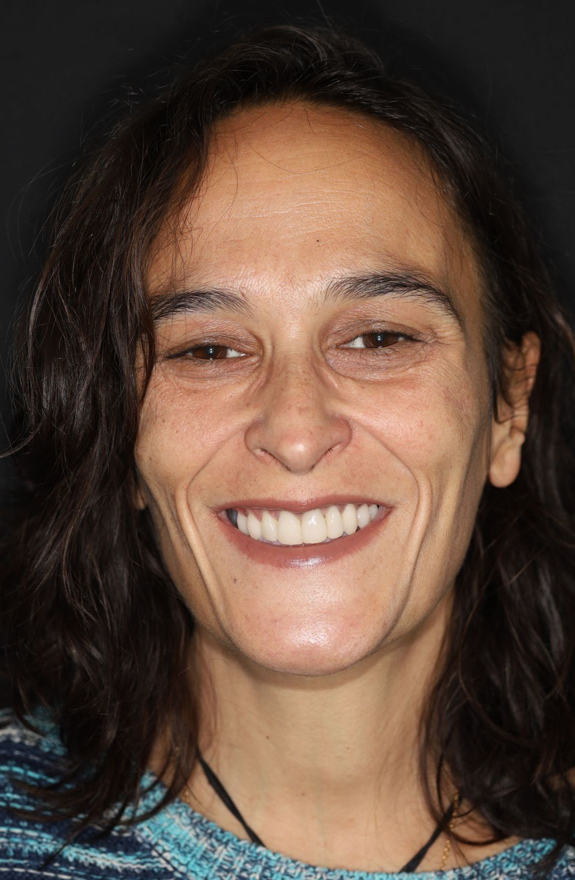 implantes dentales antes y despues