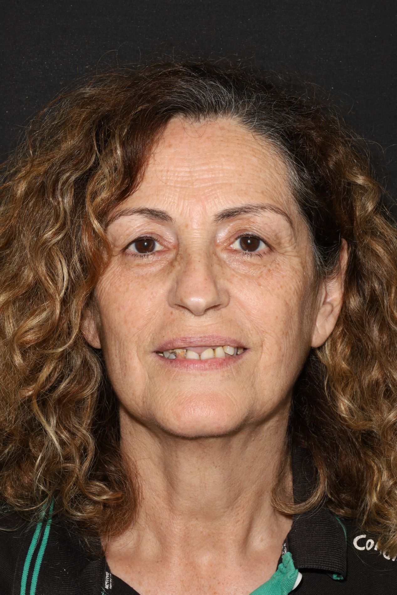 testimonio implantes dentales