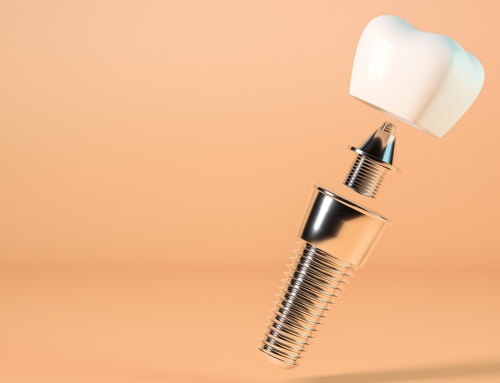 Cómo se Coloca un Implante Dental Paso a Paso: Guía Detallada