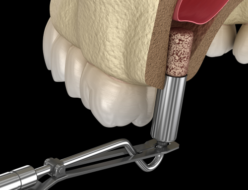 ¿Cuándo Es Necesaria una Elevación de Seno Maxilar para Colocar Implantes Dentales?